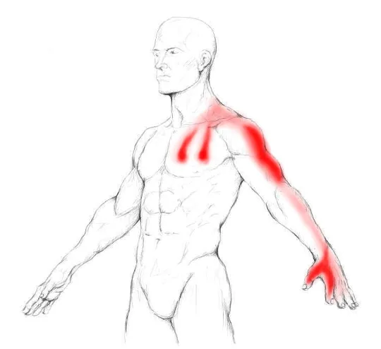 Arm / Hand Numbness — Thoracic Outlet Syndrome