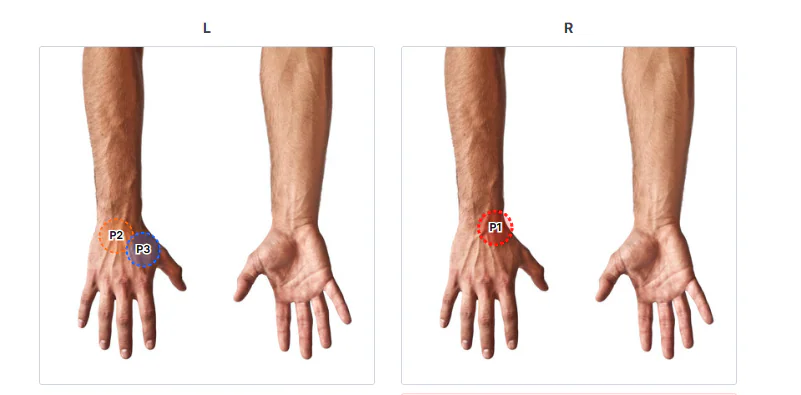Michael's pain regions. Right wrist: P1. Left wrist: P2 and P3.