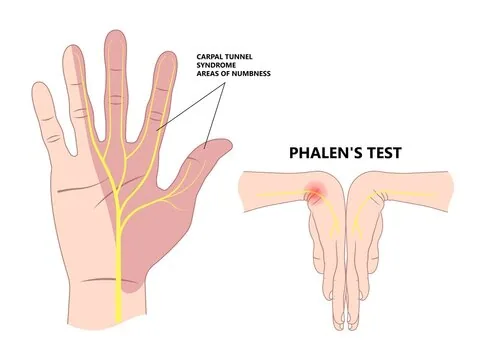 Phalen's test and median nerve areas of numbness for carpal tunnel syndrome