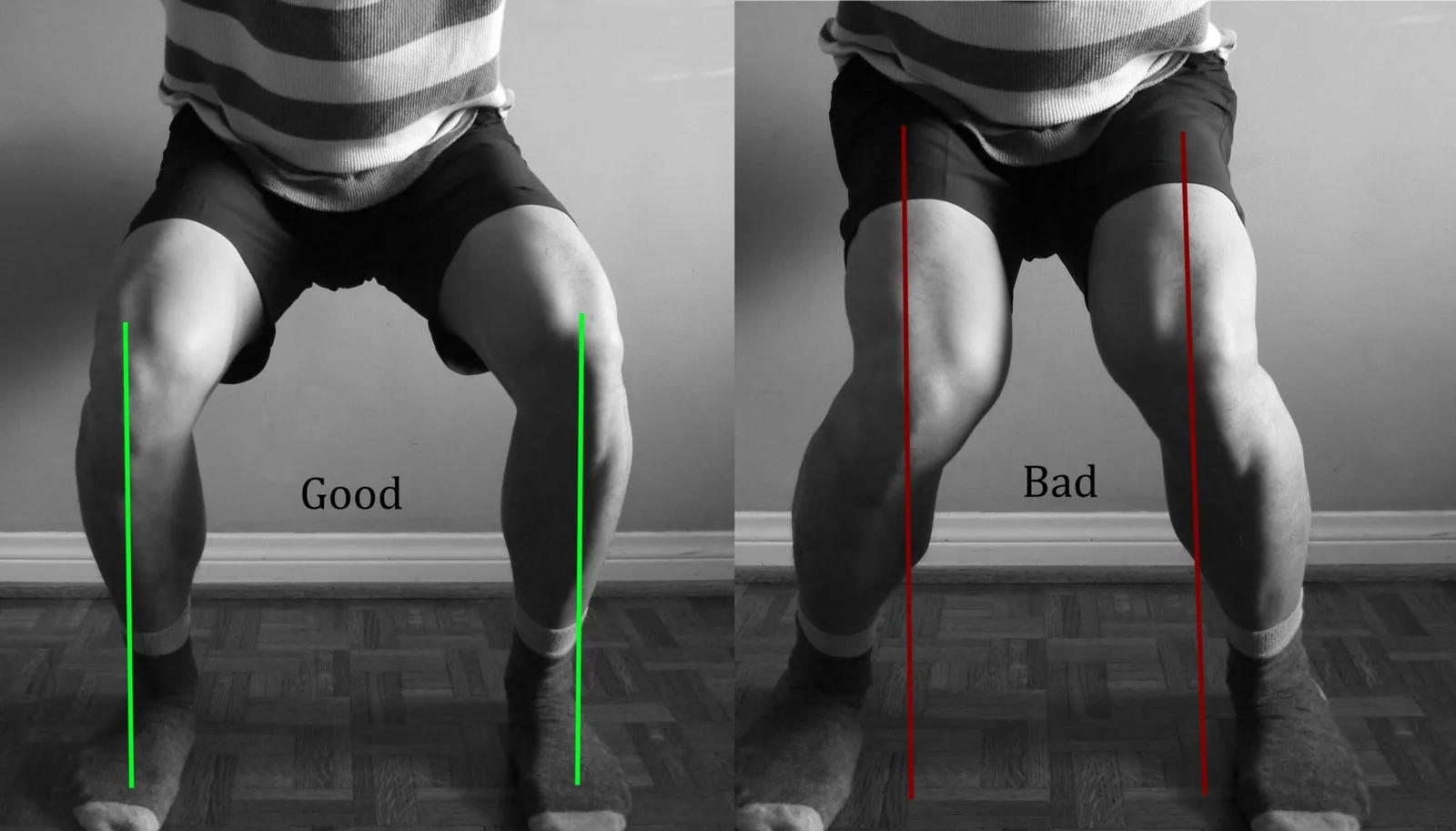 Knee Valgus