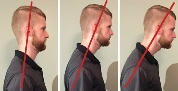 from left to right, image of a man with a red line indicating increasing positions of forward head posture