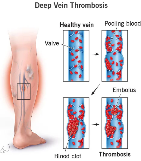 Gaming Injuries