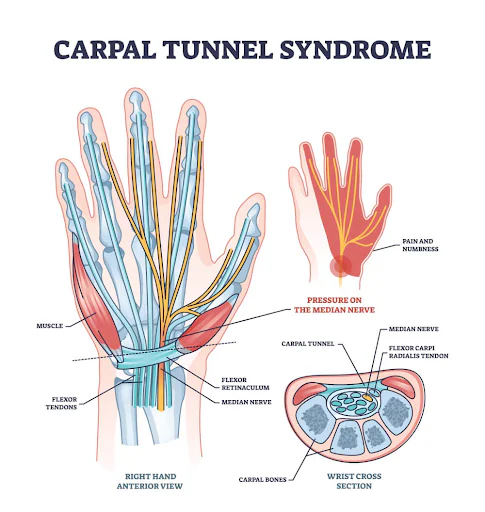 carpal tunnel syndrome
