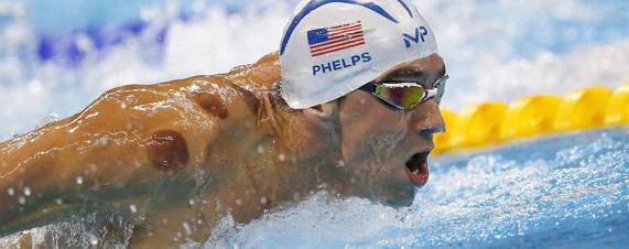Cupping