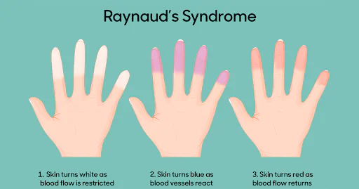 Raynaud's Syndrome