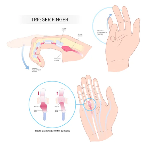 trigger finger