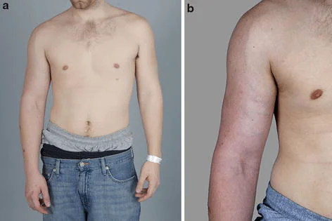 Discoloration From Impinged Veins