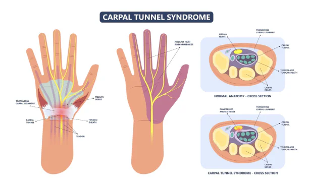 TOS vs. Carpal Tunnel Syndrome