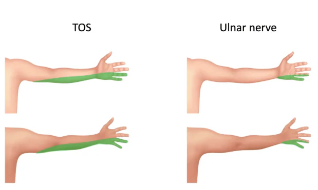 TOS vs. Cubital Tunnel Syndrome