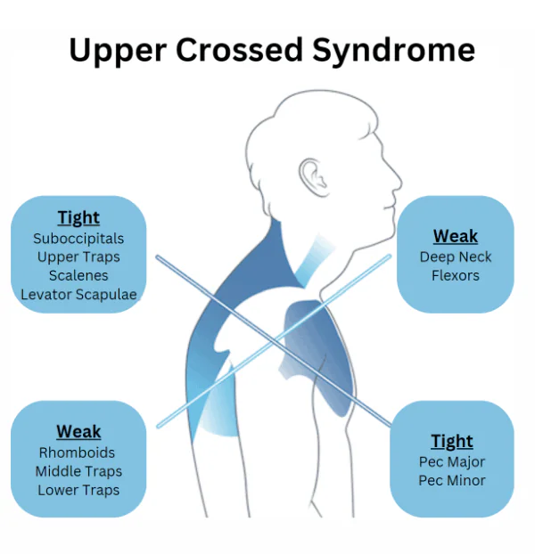 Upper Crossed Syndrome