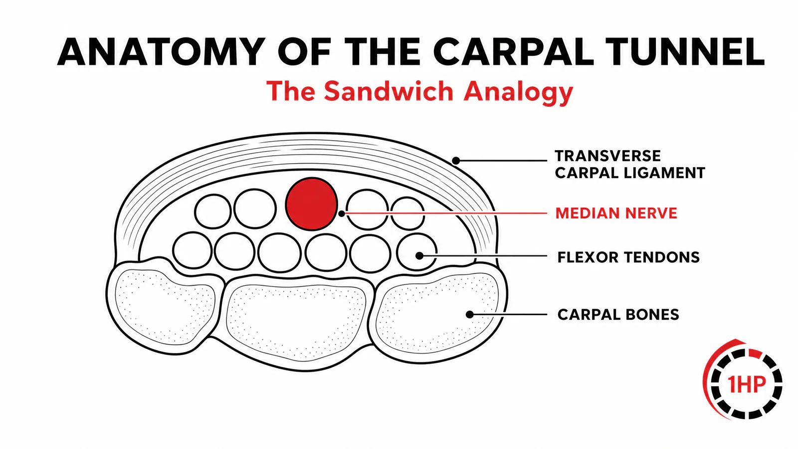 The Carpal Tunnel Sandwich: How swollen tendons compress the median nerve causing carpal tunnel syndrome symptoms