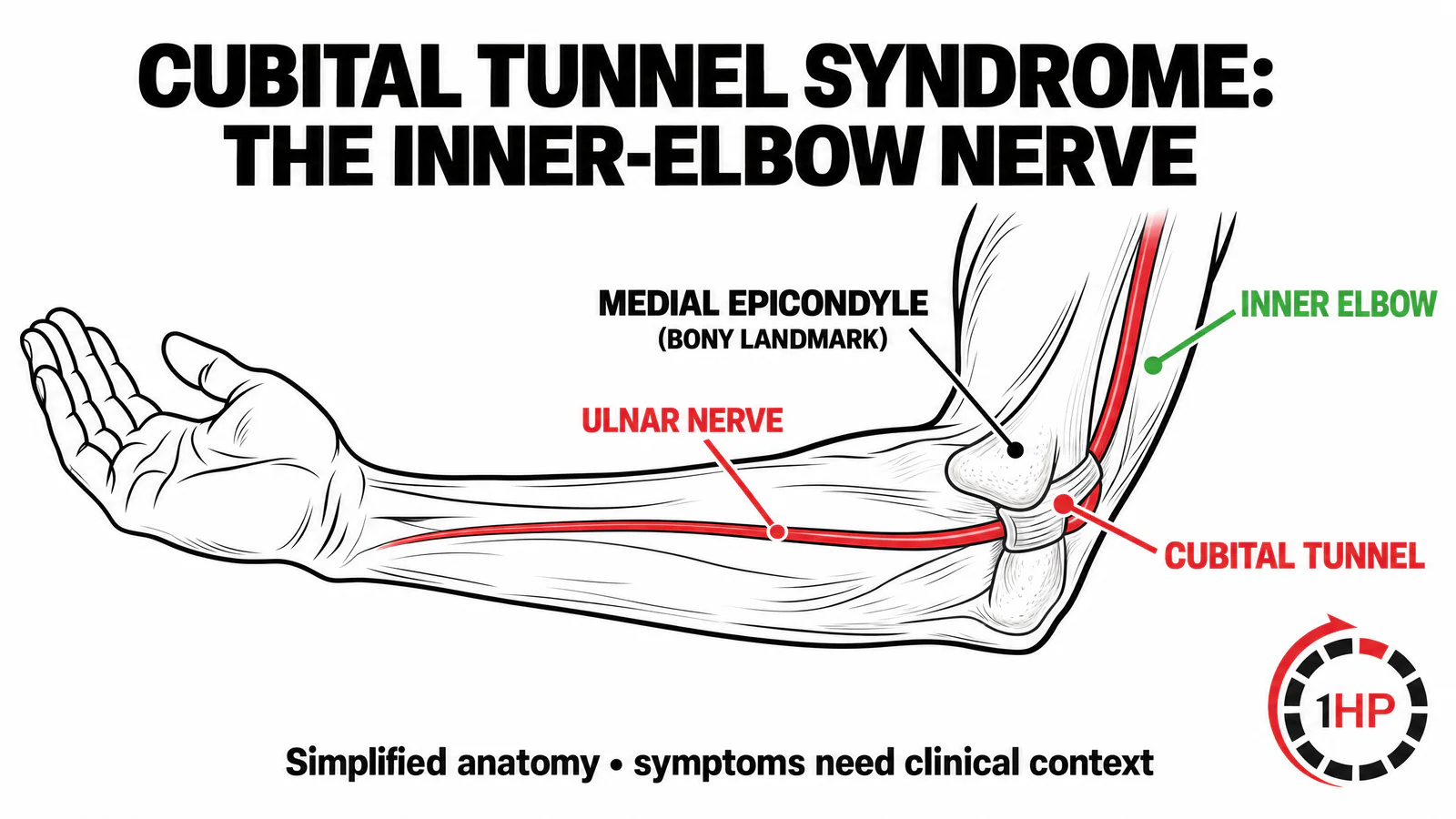 Cubital tunnel syndrome anatomy graphic showing the ulnar nerve passing through the inner elbow cubital tunnel.
