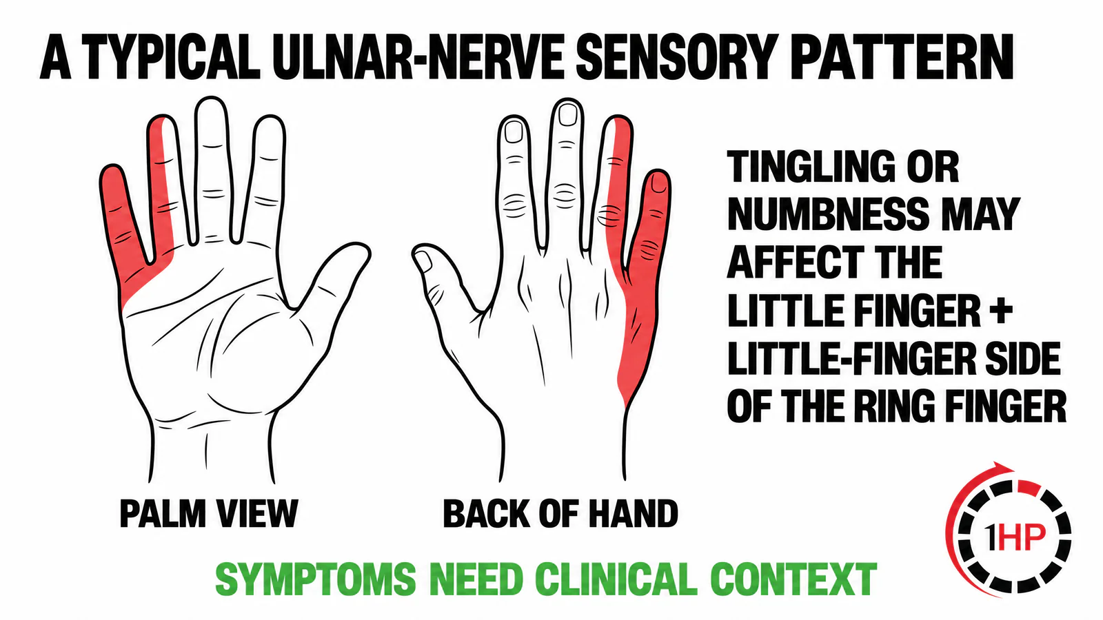 Cubital tunnel syndrome sensory map highlighting the little finger and little-finger side of the ring finger with a clinical-context note.