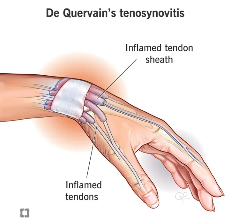 Dentist hand pain source graphic illustrating thumb-side wrist symptoms during clinical instrument use