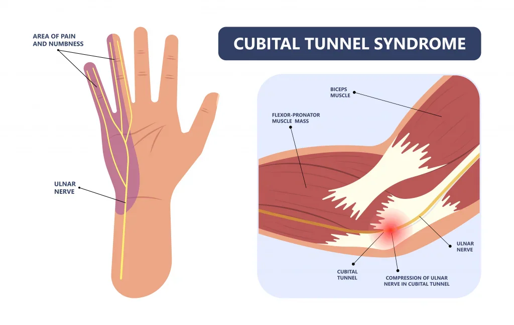 Dentist hand pain source graphic showing an ulnar pattern in the ring and little fingers