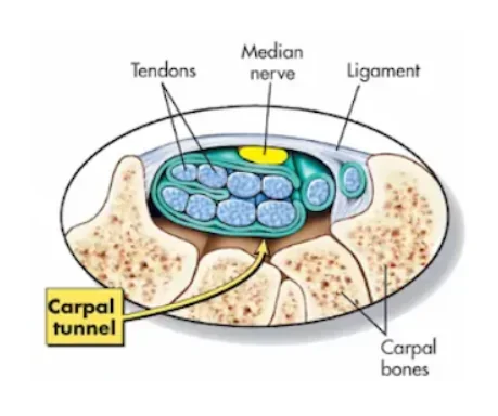 Dentist hand pain source graphic showing carpal tunnel anatomy and the median nerve