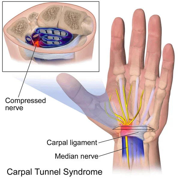 Dentist hand pain source graphic discussing carpal tunnel assessment and anatomy