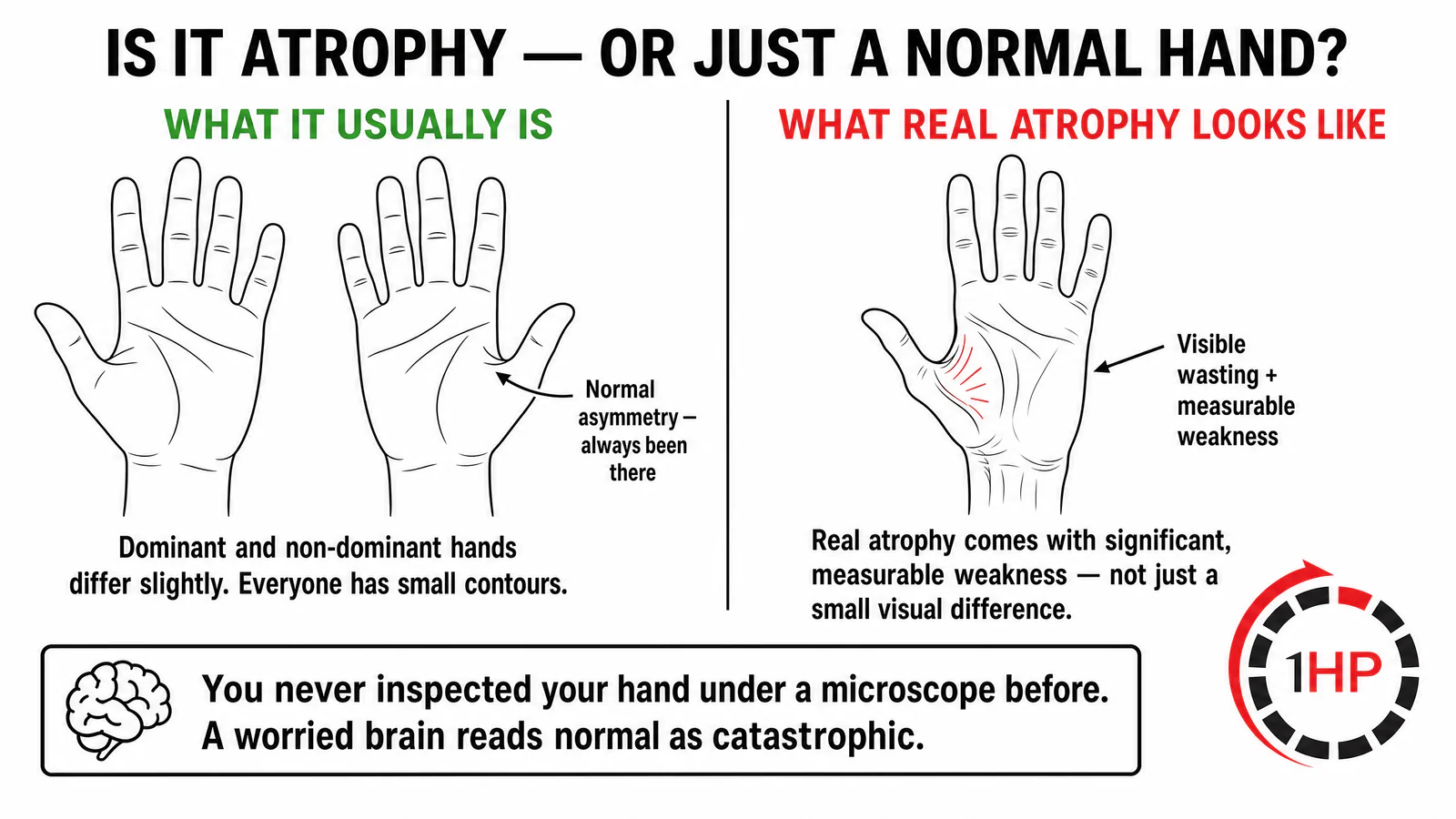 Comparison showing normal hand asymmetry versus visible muscle atrophy