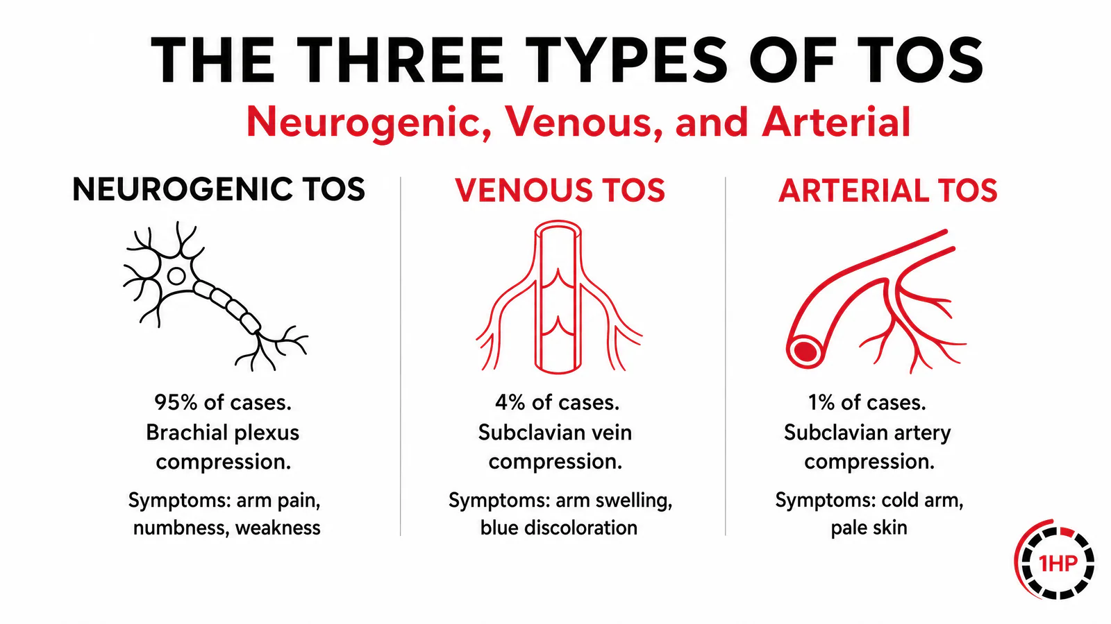 The Three Tunnels of the Thoracic Outlet