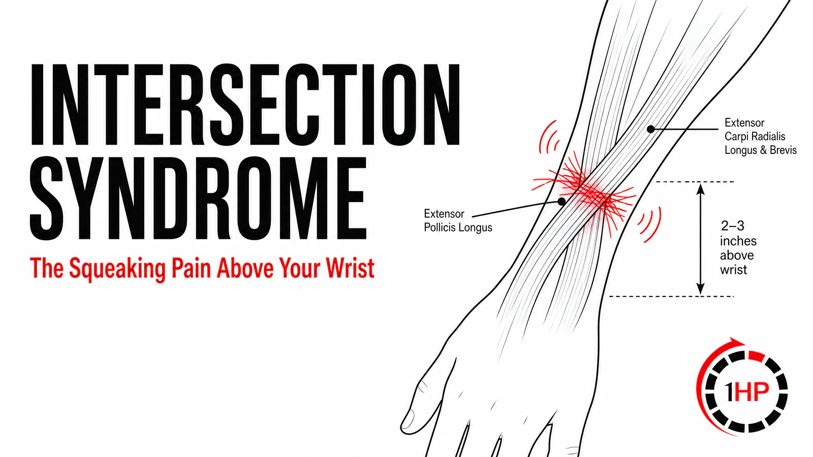 Intersection Syndrome: The Squeaking Pain Above Your Wrist