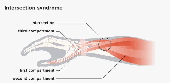 Intersection syndrome anatomy