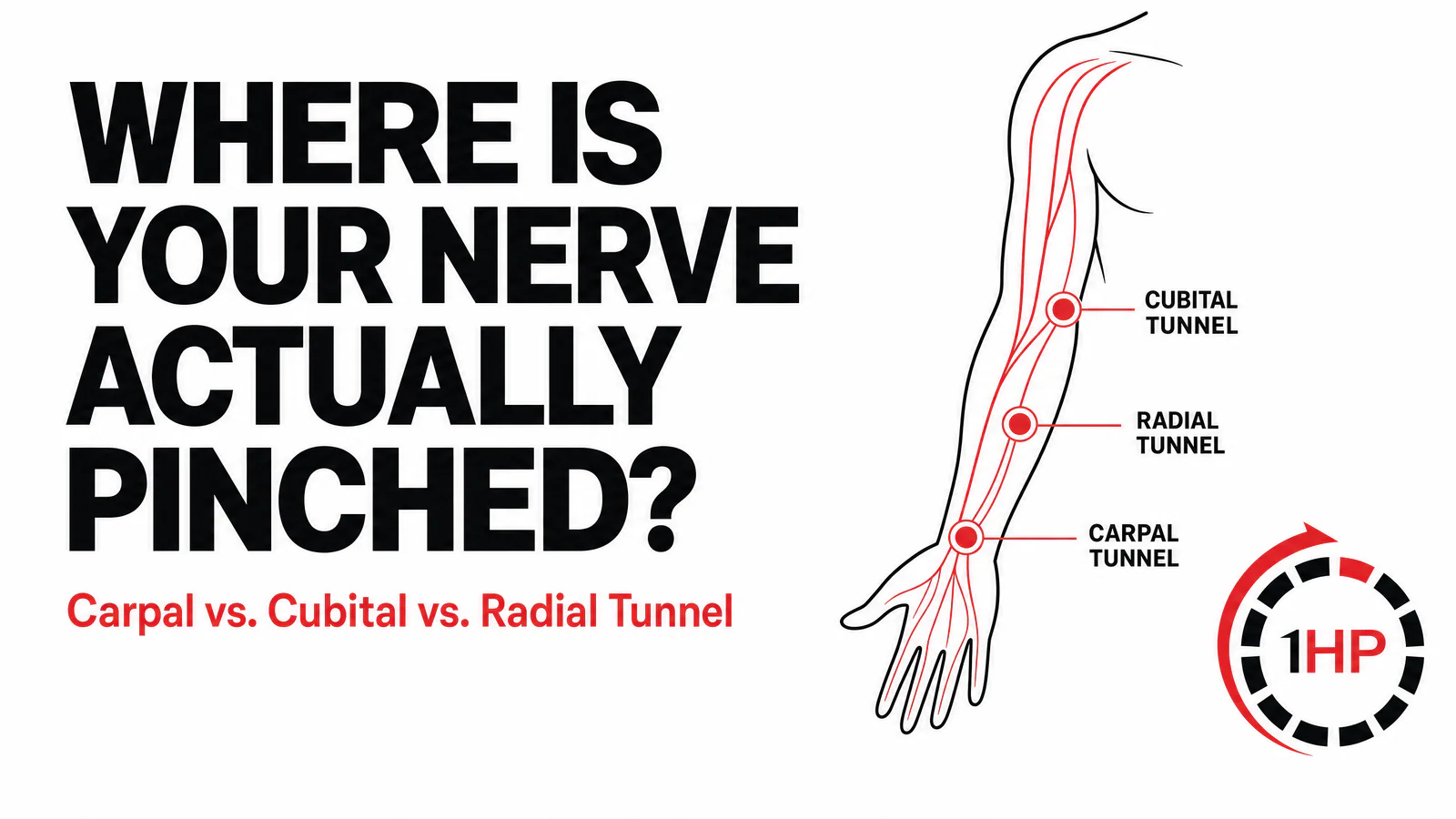 Nerve Compression in the Arm: Carpal vs Cubital vs Radial Tunnel