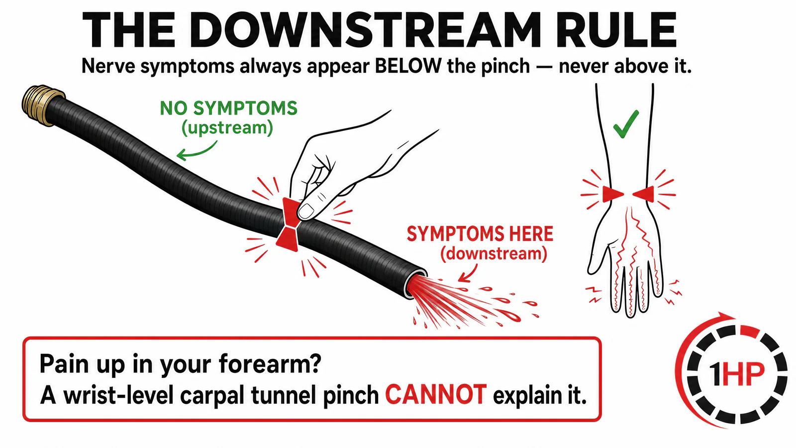 The downstream rule of nerve compression in the arm showing symptoms appear below the pinch