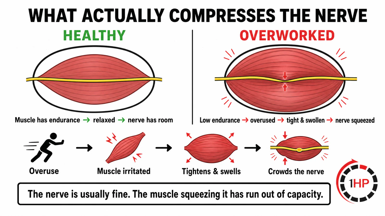 Cross section showing how overworked muscle causes nerve compression in the arm