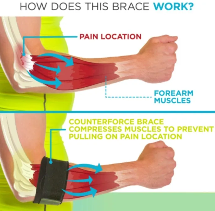 Tennis elbow brace