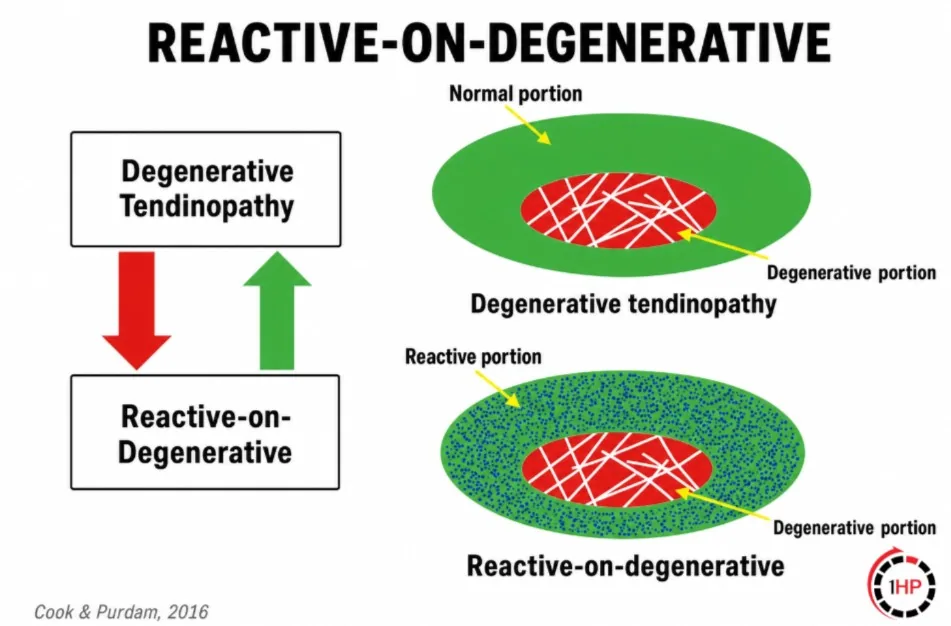 Reactive on degenerative tendinopathy, Cook and Purdam, Treat the donut not the hole